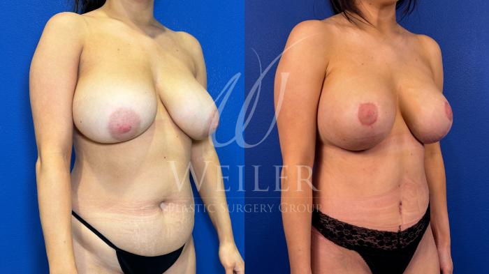 Before & After Breast Lift with Augmentation Case 1573 Right Oblique View in Baton Rouge, New Orleans, & Lafayette, Louisiana