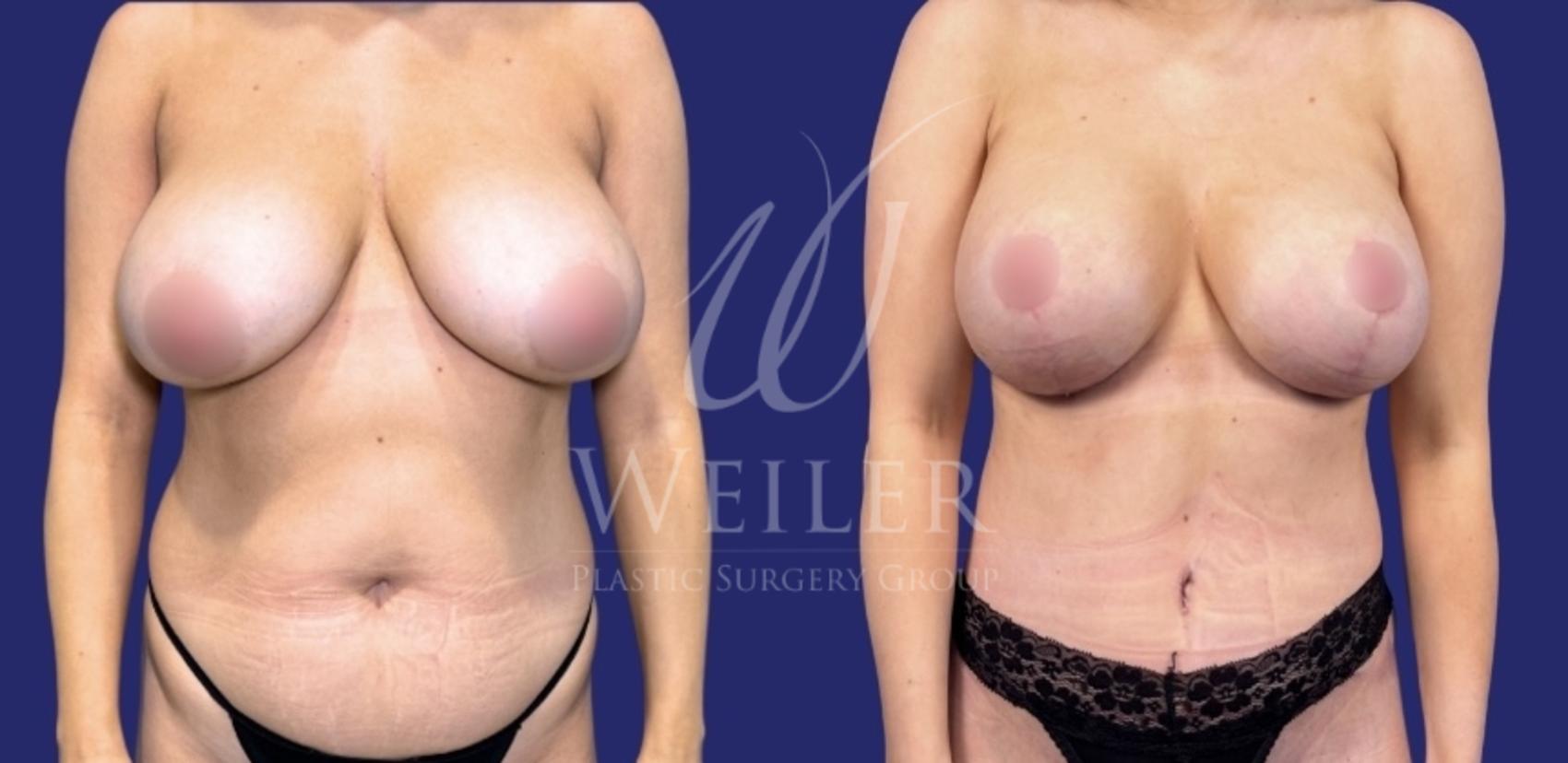 Before & After Mommy Makeover Case 1588 Front View in Baton Rouge, New Orleans, & Lafayette, Louisiana