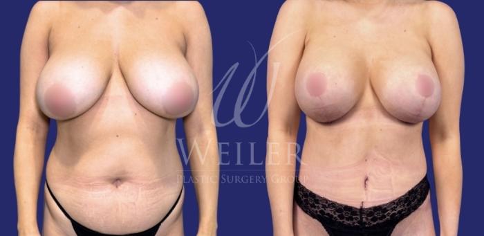 Before & After Mommy Makeover Case 1588 Front View in Baton Rouge, New Orleans, & Lafayette, Louisiana
