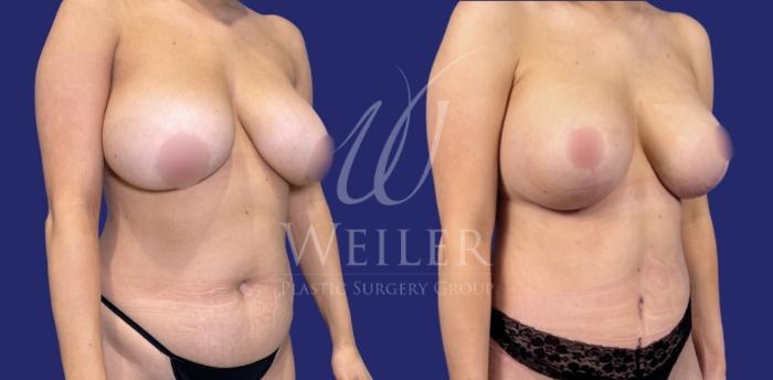 Before & After Mommy Makeover Case 1588 Right Oblique View in Baton Rouge, New Orleans, & Lafayette, Louisiana