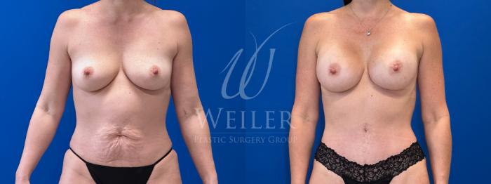 Before & After Mommy Makeover Case 1590 Front View in Baton Rouge, New Orleans, & Lafayette, Louisiana