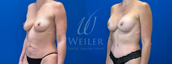 Before & After Mommy Makeover Case 1590 Left Oblique View in Baton Rouge, New Orleans, & Lafayette, Louisiana