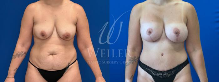 Before & After Breast Lift with Augmentation Case 1592 Front View in Baton Rouge, New Orleans, & Lafayette, Louisiana