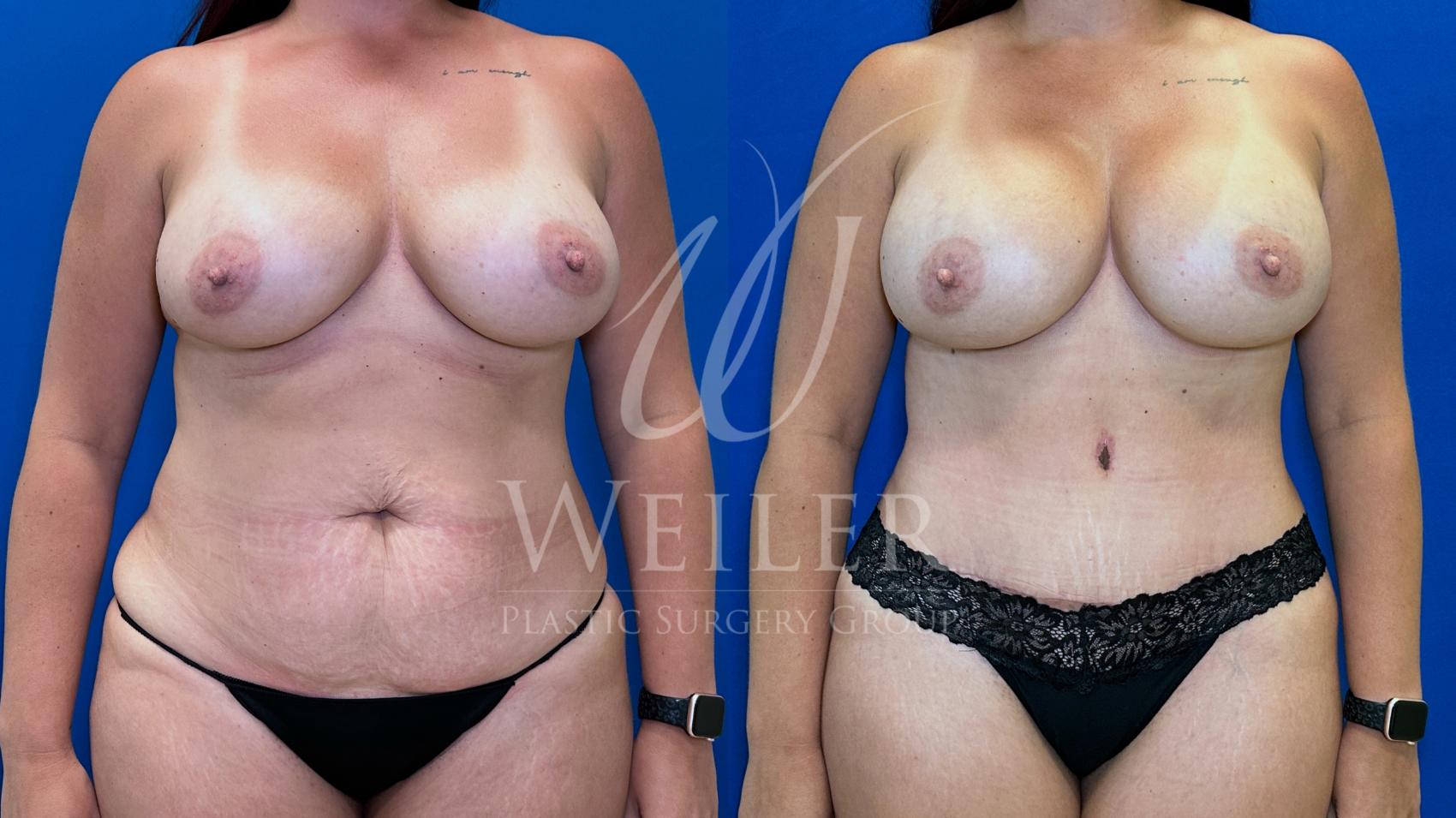Before & After Breast Revision Case 1634 Front View in Baton Rouge, New Orleans, & Lafayette, Louisiana