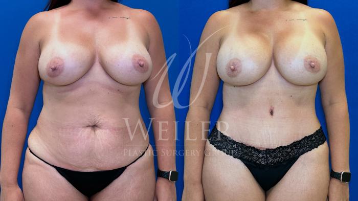 Before & After Breast Revision Case 1634 Front View in Baton Rouge, New Orleans, & Lafayette, Louisiana