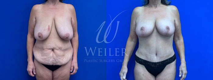 Before & After Mommy Makeover Case 1635 Front View in Baton Rouge, New Orleans, & Lafayette, Louisiana