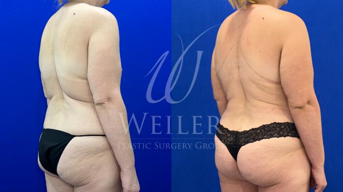 Before & After Mommy Makeover Case 1650 Back- Right Oblique View in Baton Rouge, New Orleans, & Lafayette, Louisiana