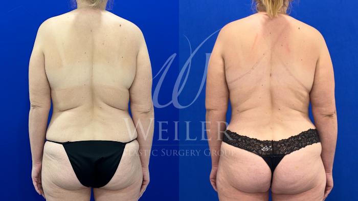 Before & After Mommy Makeover Case 1650 Back View in Baton Rouge, New Orleans, & Lafayette, Louisiana