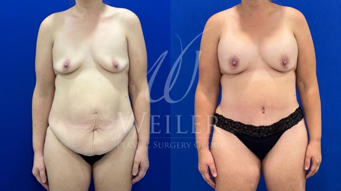 Before & After Mommy Makeover Case 1650 Front View in Baton Rouge, New Orleans, & Lafayette, Louisiana