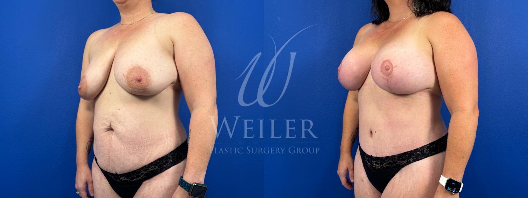 Before & After Mommy Makeover Case 1670 Left Oblique View in Baton Rouge, New Orleans, & Lafayette, Louisiana