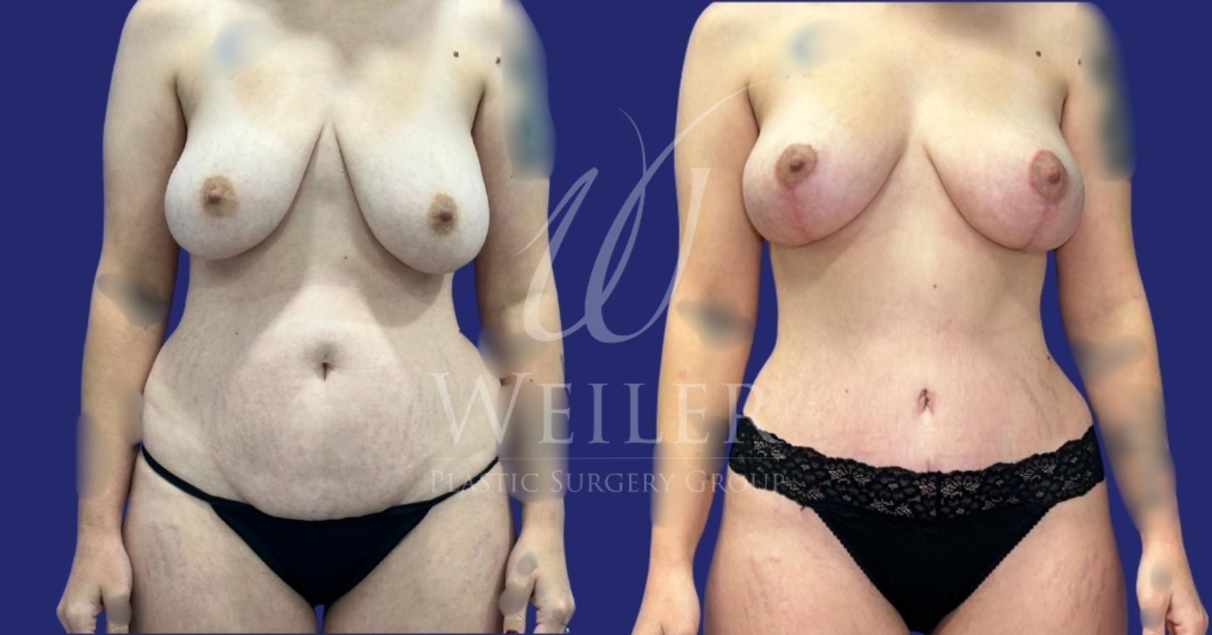 Before & After Mommy Makeover Case 1683 Front View in Baton Rouge, New Orleans, & Lafayette, Louisiana