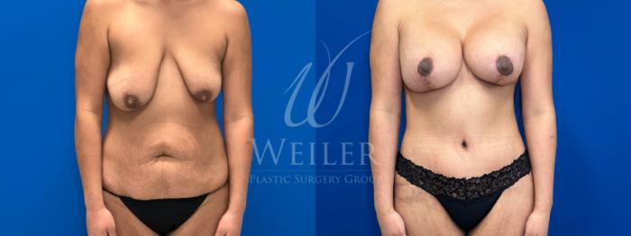 Before & After Mommy Makeover Case 1778 Front View in Baton Rouge, New Orleans, & Lafayette, Louisiana