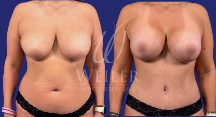 Before & After Mommy Makeover Case 1781 Front View in Baton Rouge, New Orleans, & Lafayette, Louisiana