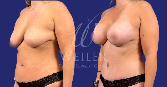Before & After Mommy Makeover Case 1781 Left Oblique View in Baton Rouge, New Orleans, & Lafayette, Louisiana