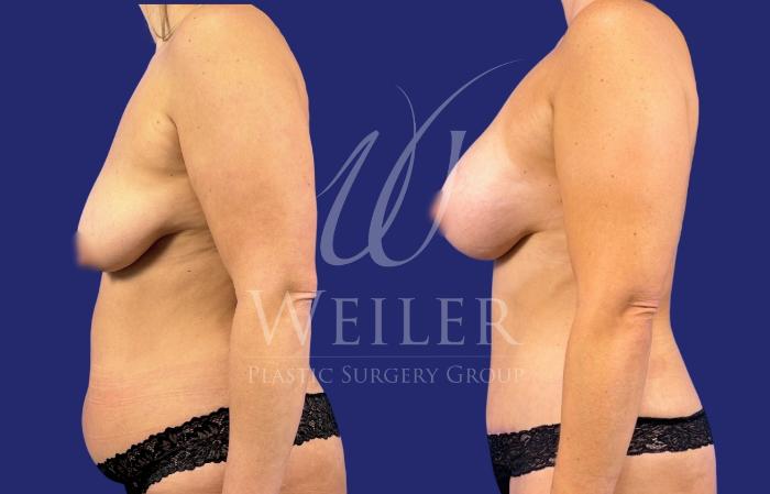 Before & After Mommy Makeover Case 1781 Left Side View in Baton Rouge, New Orleans, & Lafayette, Louisiana