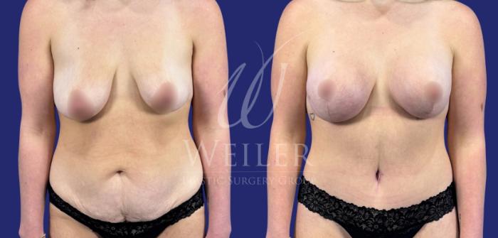 Before & After Mommy Makeover Case 1783 Front View in Baton Rouge, New Orleans, & Lafayette, Louisiana