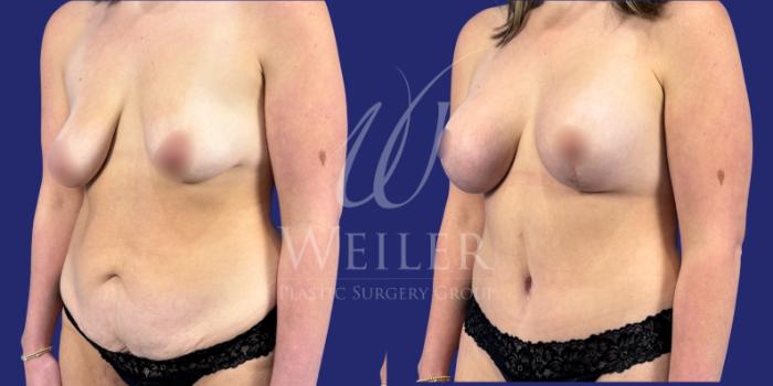 Before & After Mommy Makeover Case 1783 Left Oblique View in Baton Rouge, New Orleans, & Lafayette, Louisiana