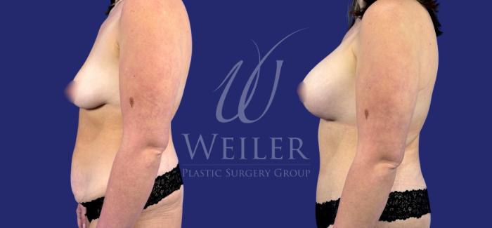 Before & After Mommy Makeover Case 1783 Left Side View in Baton Rouge, New Orleans, & Lafayette, Louisiana