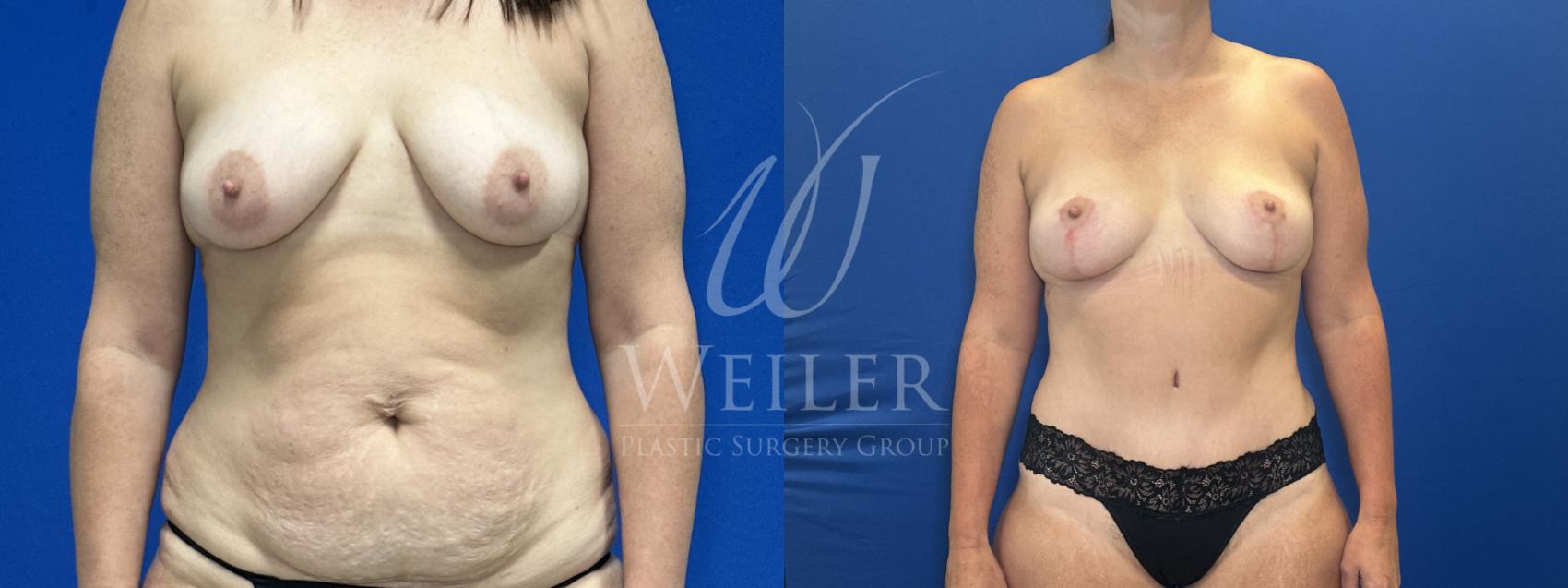 Before & After Mommy Makeover Case 1827 Front View in Baton Rouge, New Orleans, & Lafayette, Louisiana