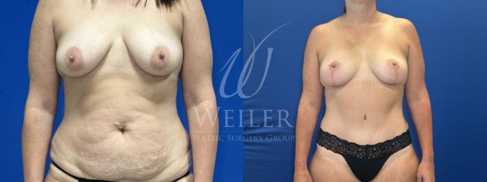 Before & After Mommy Makeover Case 1827 Front View in Baton Rouge, New Orleans, & Lafayette, Louisiana