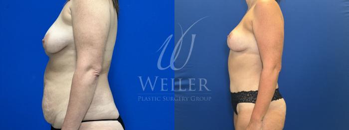 Before & After Mommy Makeover Case 1827 Left Side View in Baton Rouge, New Orleans, & Lafayette, Louisiana
