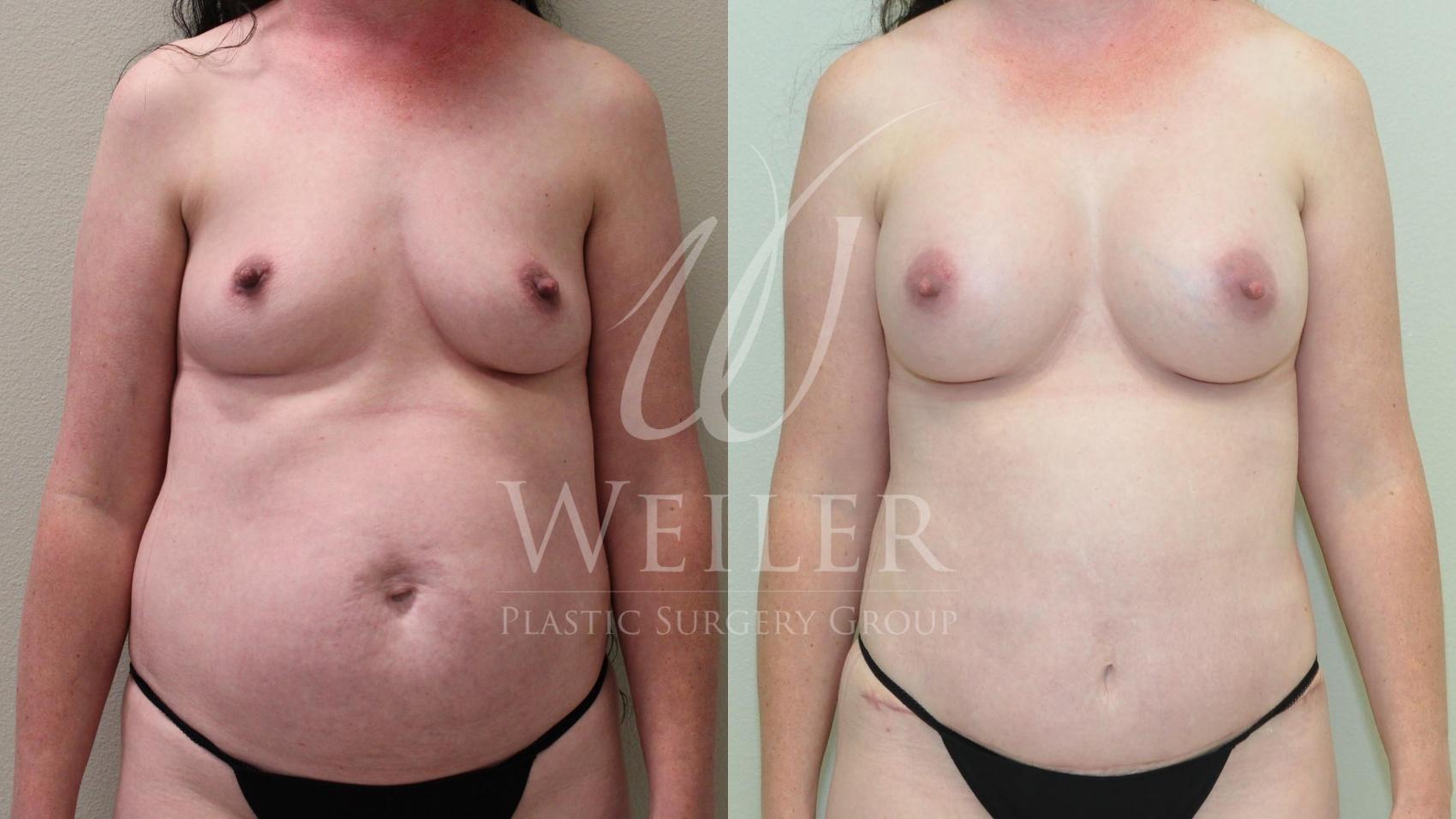 Before & After Breast Augmentation Case 213 View #1 View in Baton Rouge, New Orleans, & Lafayette, Louisiana
