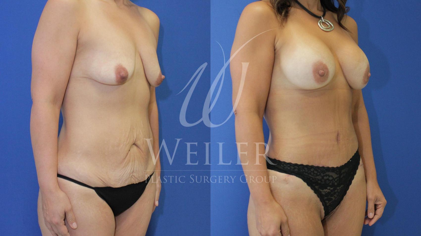 Before & After Mommy Makeover Case 506 Right Oblique View in Baton Rouge, Louisiana
