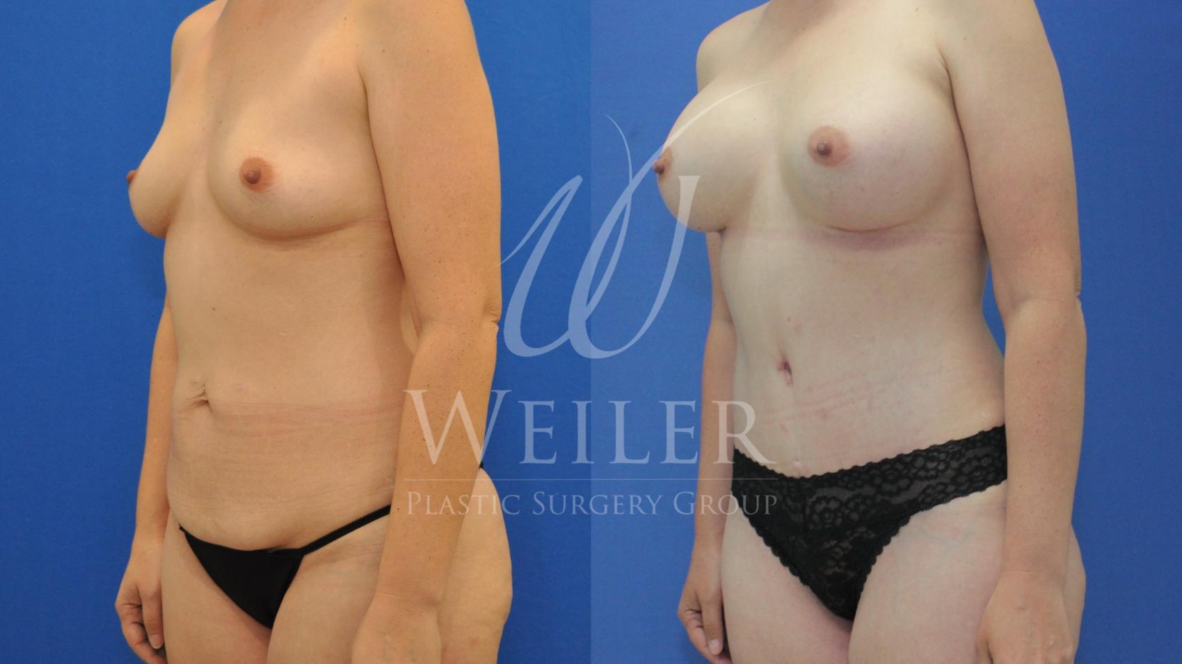 Before & After Mommy Makeover Case 590 Left Oblique View in Baton Rouge, Louisiana