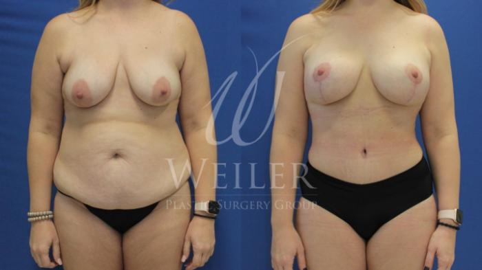 Before & After Mommy Makeover Case 683 Front View in Baton Rouge, Louisiana