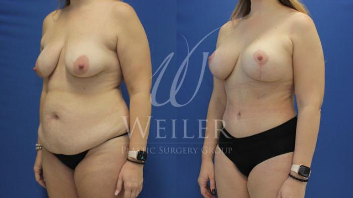 Before & After Mommy Makeover Case 683 Left Oblique View in Baton Rouge, Louisiana