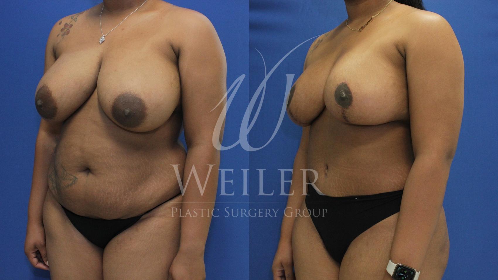 Before & After Mommy Makeover Case 695 Left Oblique View in Baton Rouge, Louisiana