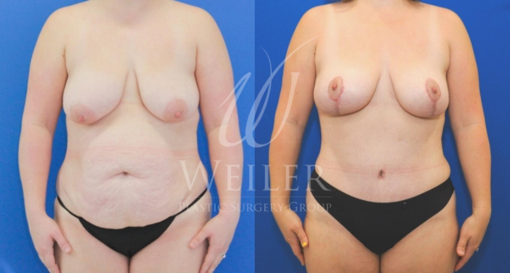 Before & After Tummy Tuck Case 724 Front View in Baton Rouge, Louisiana