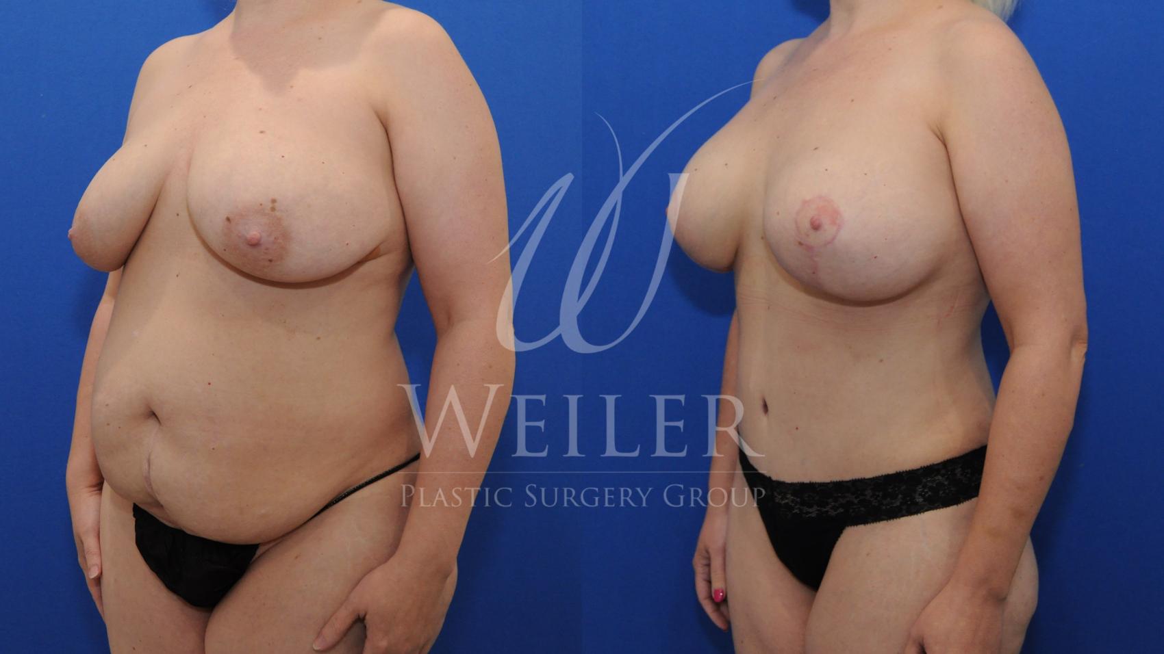 Before & After Mommy Makeover Case 795 Left Oblique View in Baton Rouge, Louisiana