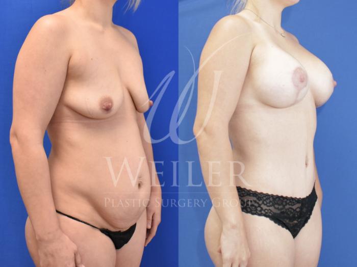 Before & After Mommy Makeover Case 820 Right Oblique View in Baton Rouge, Louisiana