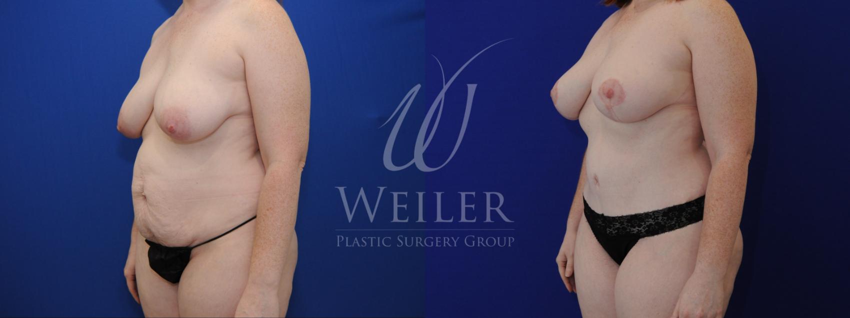 Before & After Mommy Makeover Case 824 Left Oblique View in Baton Rouge, Louisiana