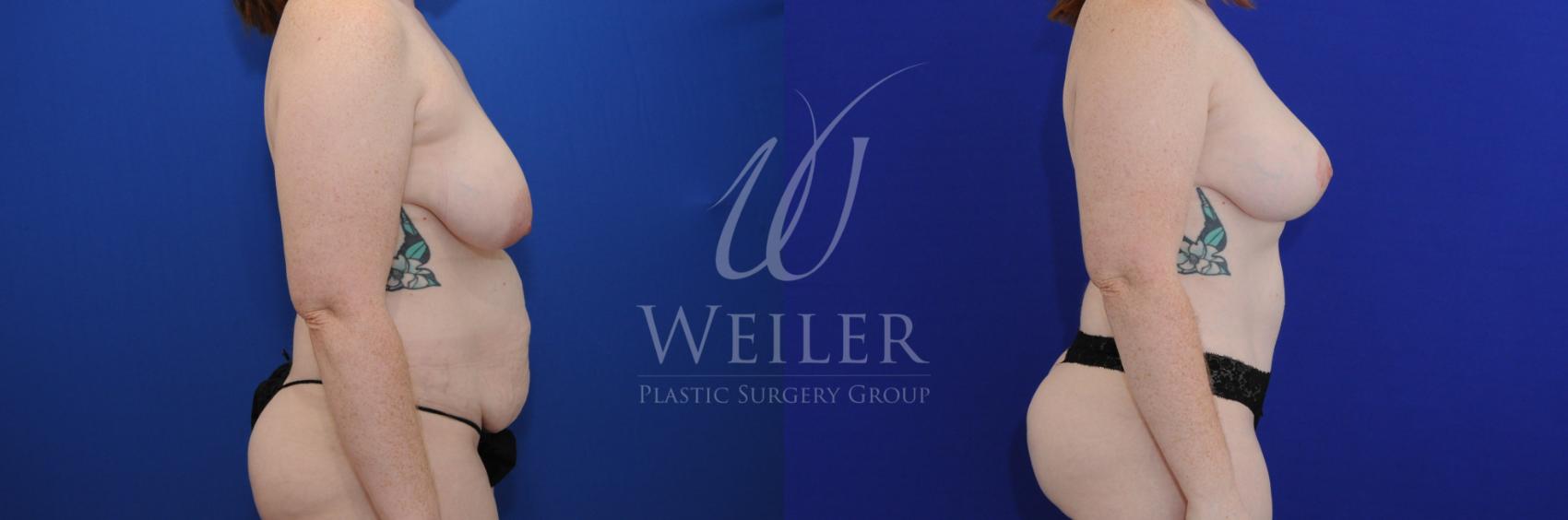 Before & After Mommy Makeover Case 824 Right Side View in Baton Rouge, Louisiana