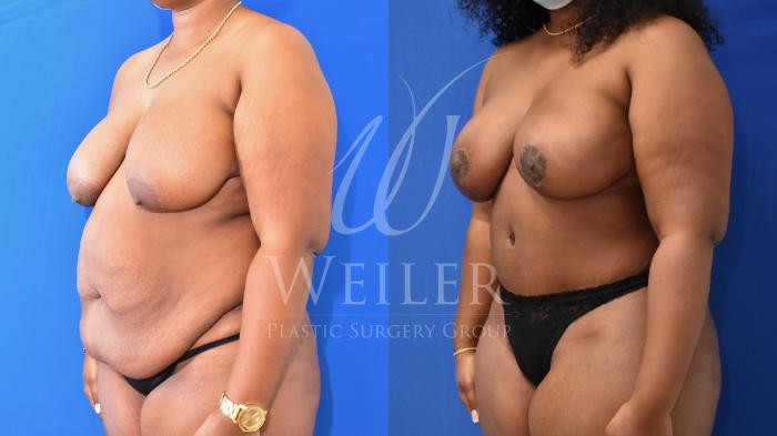 Before & After Mommy Makeover Case 835 Left Oblique View in Baton Rouge, Louisiana