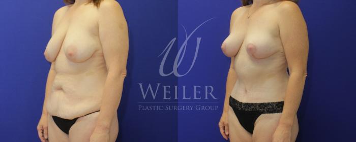 Before & After Mommy Makeover Case 879 Left Oblique View in Baton Rouge, Louisiana