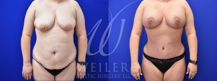 Breast Augmentation Before & After, Case 54, Female, age 25 – 34