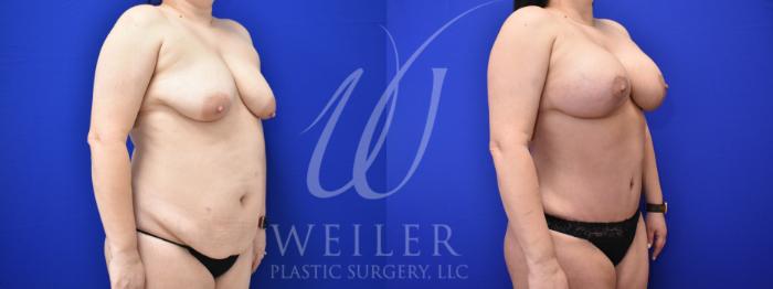 Before & After Mommy Makeover Case 898 Right Oblique View in Baton Rouge, Louisiana