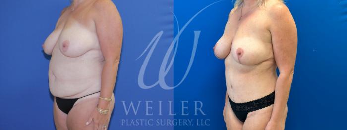 Before & After Mommy Makeover Case 919 Left Oblique View in Baton Rouge, New Orleans, & Lafayette, Louisiana