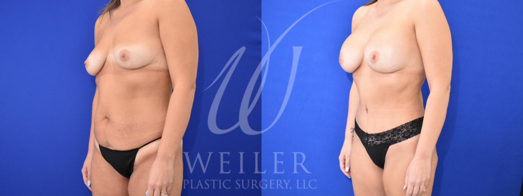Before & After Mommy Makeover Case 931 Left Oblique View in Baton Rouge, Louisiana