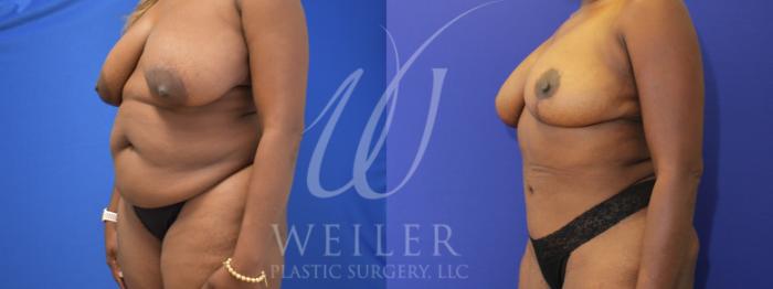 Before & After Mommy Makeover Case 955 Left Oblique View in Baton Rouge, Louisiana