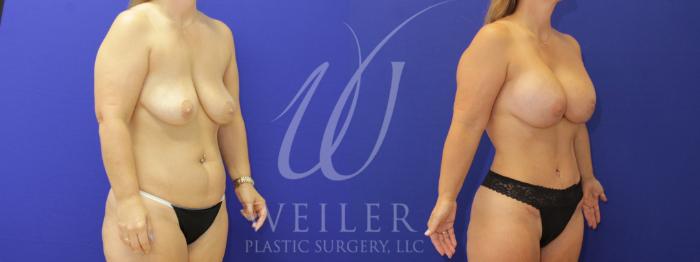 Before & After Mommy Makeover Case 999 Right Oblique View in Baton Rouge, Louisiana