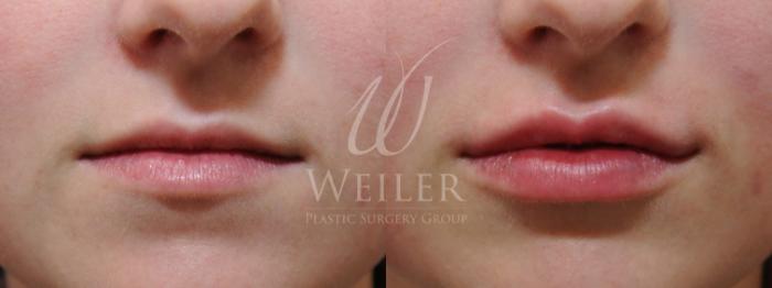 Before & After Lip Augmentation Case 816 Front View in Baton Rouge, Louisiana