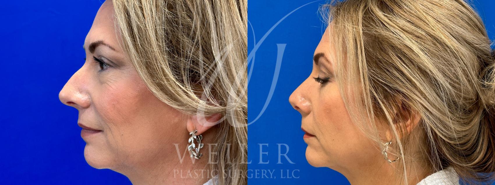 Before & After Rhinoplasty Case 1010 Left Side View in Baton Rouge, Louisiana