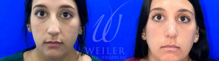 Before & After Rhinoplasty Case 1058 Front View in Baton Rouge, New Orleans, & Lafayette, Louisiana