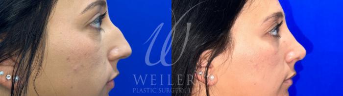 Before & After Rhinoplasty Case 1058 Right Side View in Baton Rouge, New Orleans, & Lafayette, Louisiana