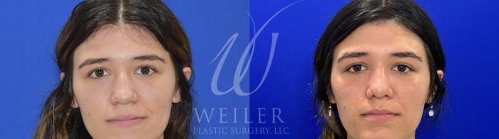 Before & After Rhinoplasty Case 1084 Front View in Baton Rouge, Louisiana