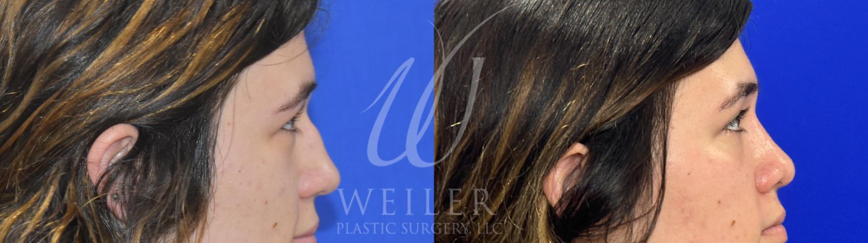 Before & After Rhinoplasty Case 1084 Right Side View in Baton Rouge, Louisiana